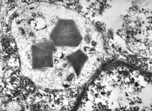 F, 35y. | crystalline inclusions in plasmocyte